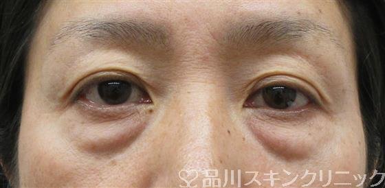 症例NO.60358のBEFORE写真