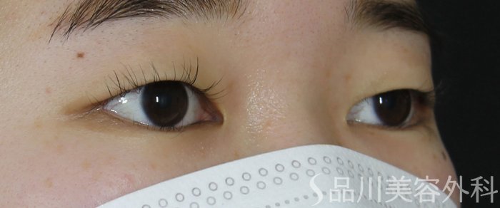 症例NO.70719のBEFORE写真