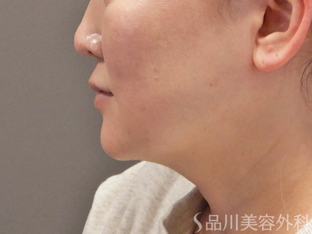 症例NO.75064のAFTER写真