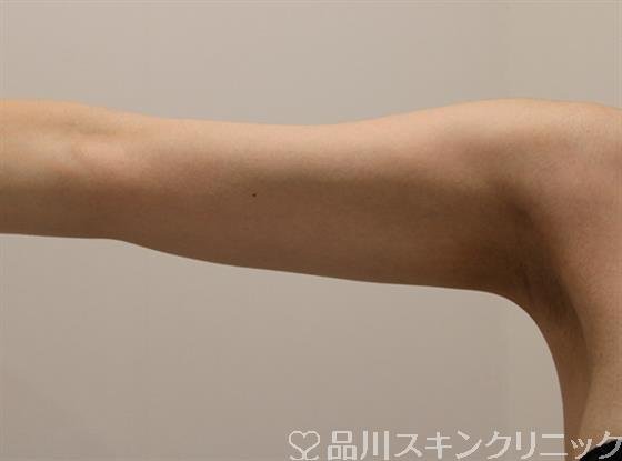 症例NO.46903のAFTER写真