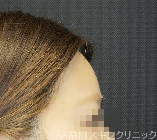 症例NO.71476のAFTER写真