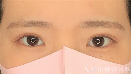 症例NO.61061のAFTER写真