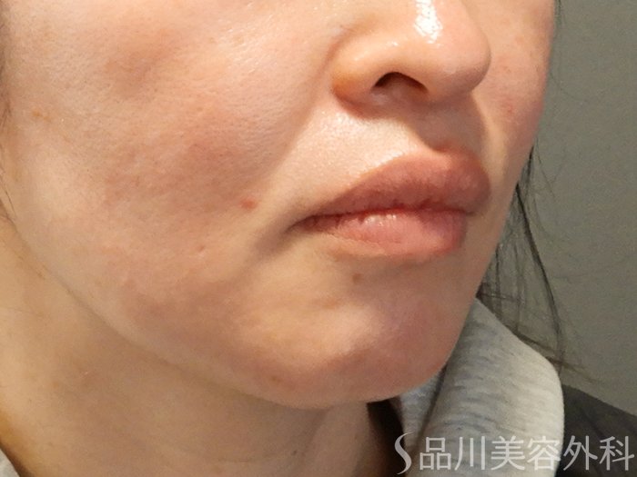 症例NO.69537のBEFORE写真