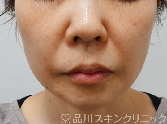 症例NO.70674のAFTER写真