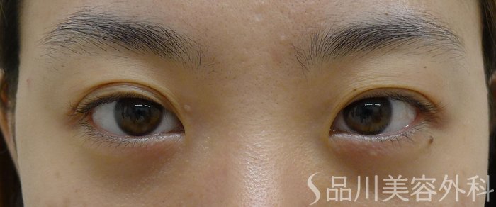 症例NO.74159のBEFORE写真