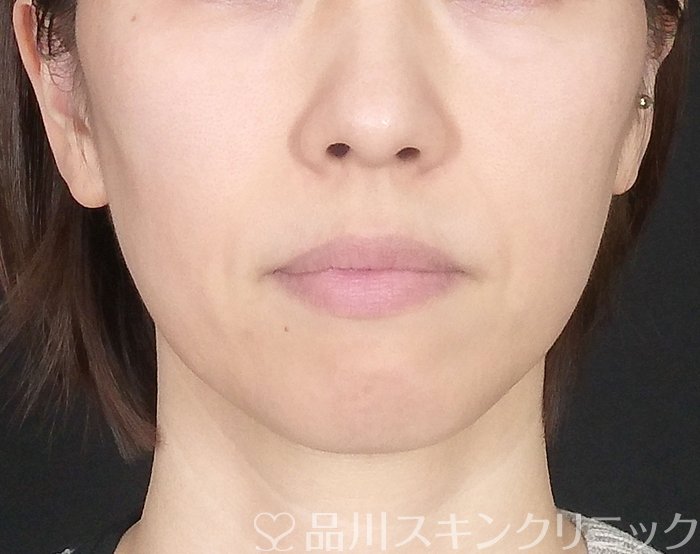 症例NO.62349のBEFORE写真