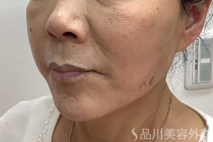 症例NO.62155のAFTER写真