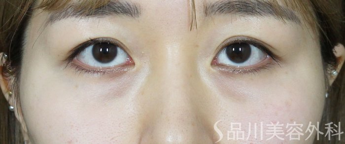 症例NO.63360のBEFORE写真