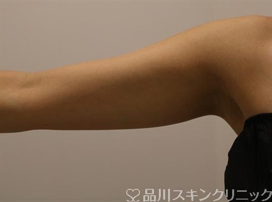 症例NO.42193のAFTER写真