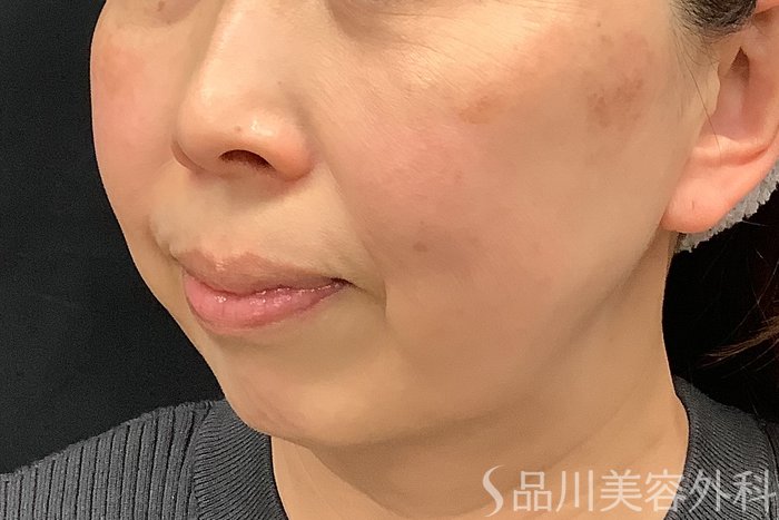 症例NO.73326のBEFORE写真