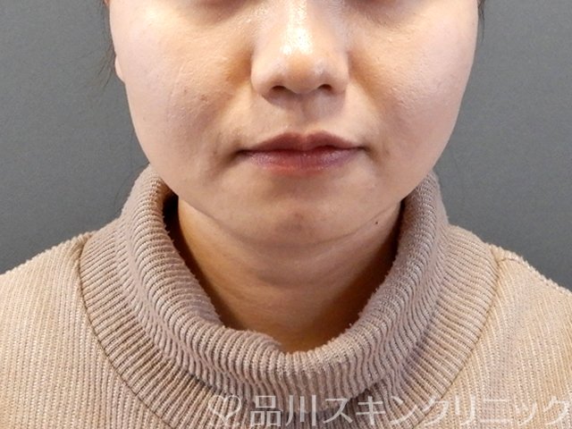 症例NO.63334のAFTER写真