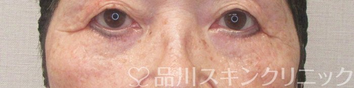 症例NO.75343のAFTER写真