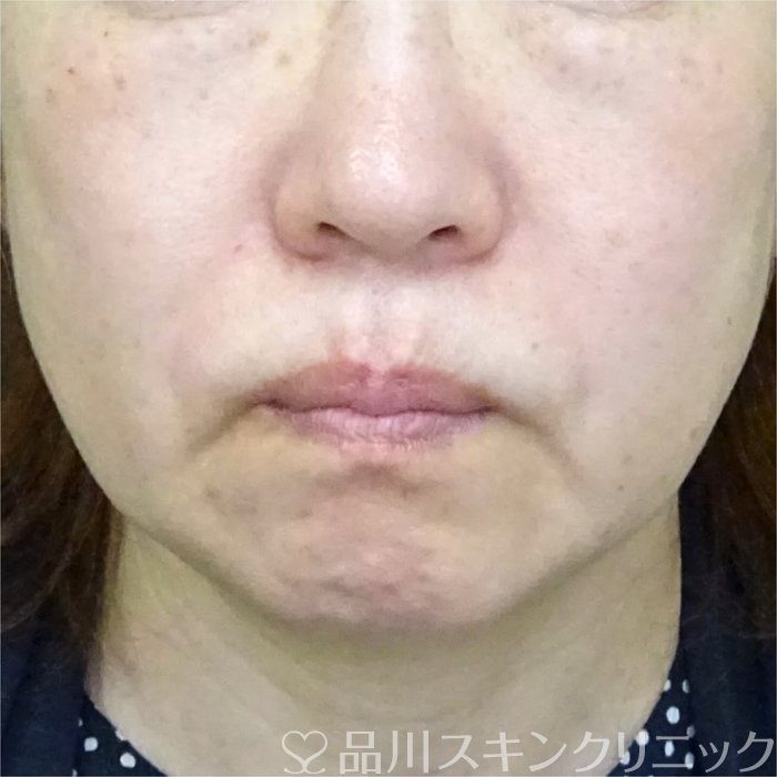 症例NO.69425のAFTER写真
