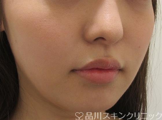 症例NO.33126のAFTER写真
