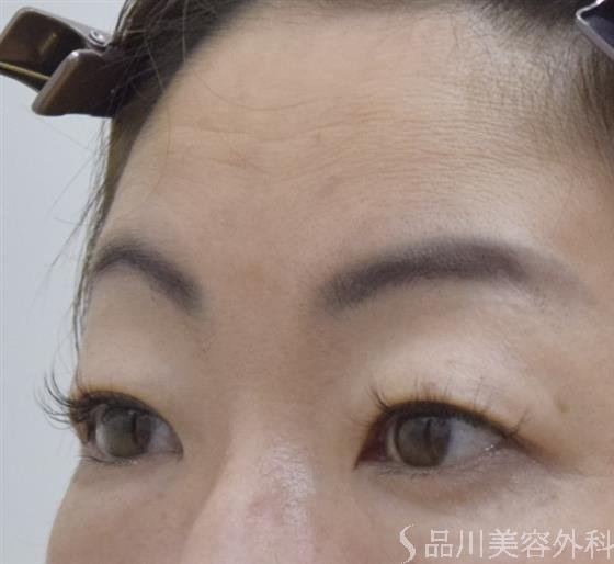 症例NO.52697のBEFORE写真