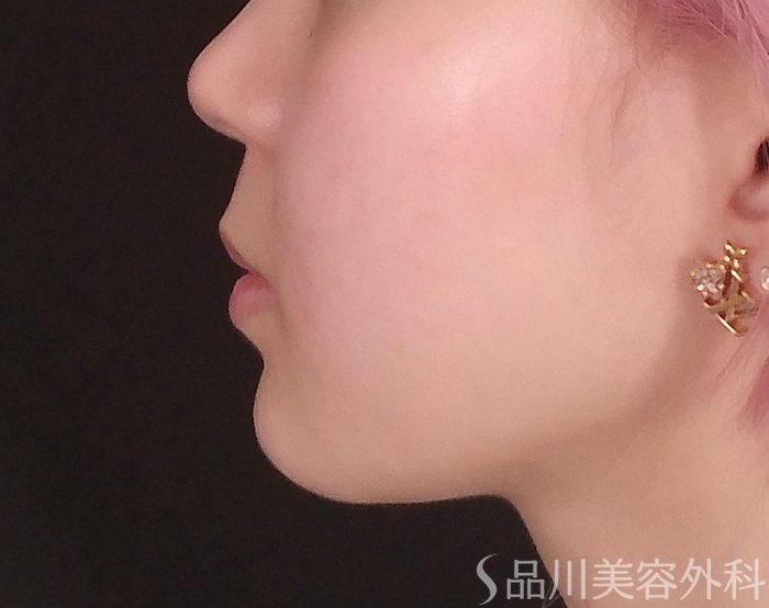 症例NO.69820のAFTER写真
