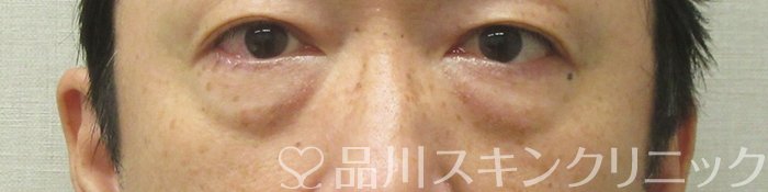 症例NO.74836のBEFORE写真
