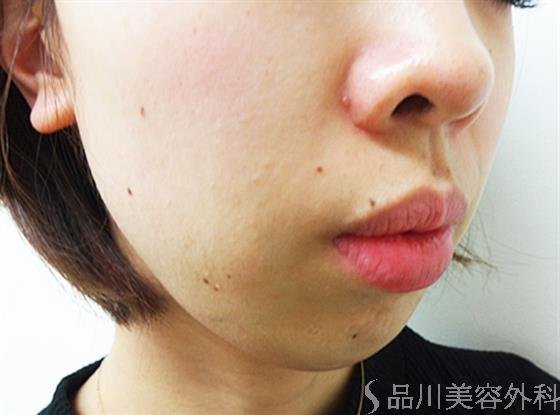 症例NO.21955のBEFORE写真