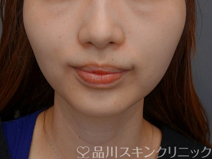 症例NO.74192のBEFORE写真