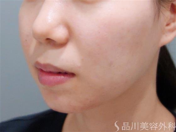 症例NO.51315のBEFORE写真