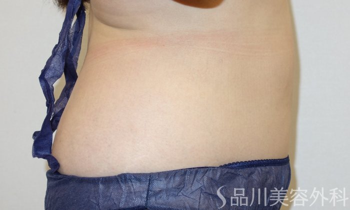 症例NO.72993のAFTER写真