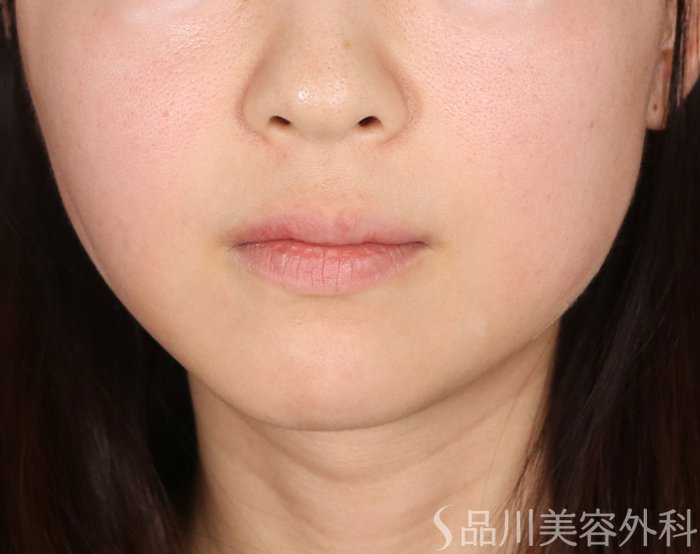 症例NO.73369のAFTER写真