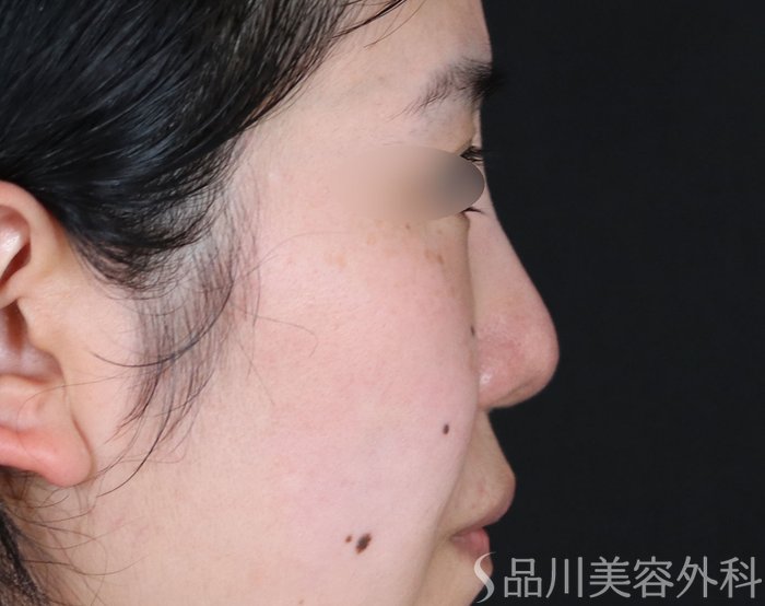 症例NO.73555のBEFORE写真