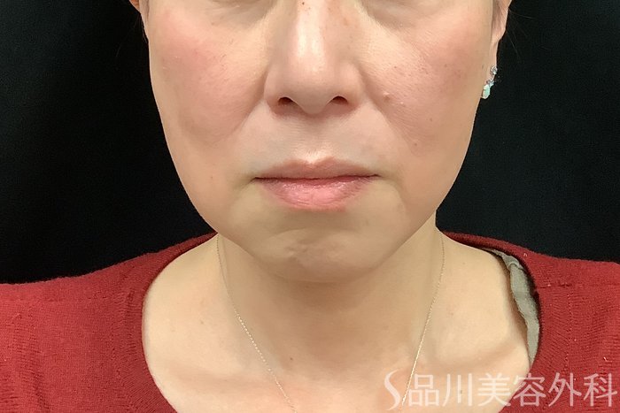 症例NO.71293のBEFORE写真