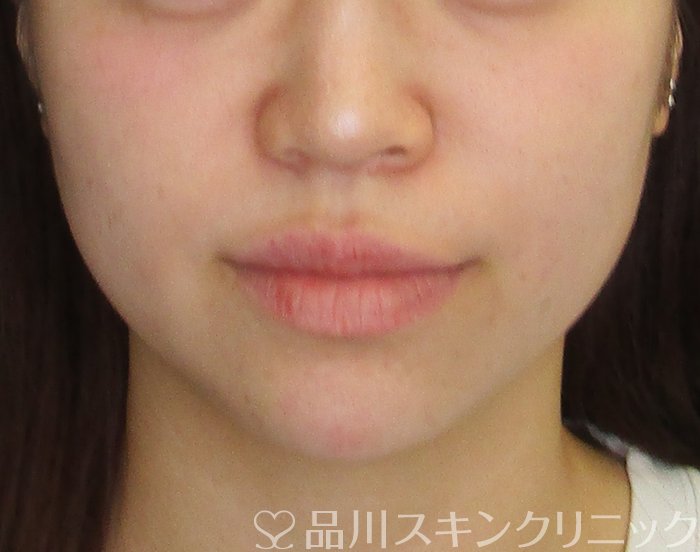 症例NO.74821のAFTER写真