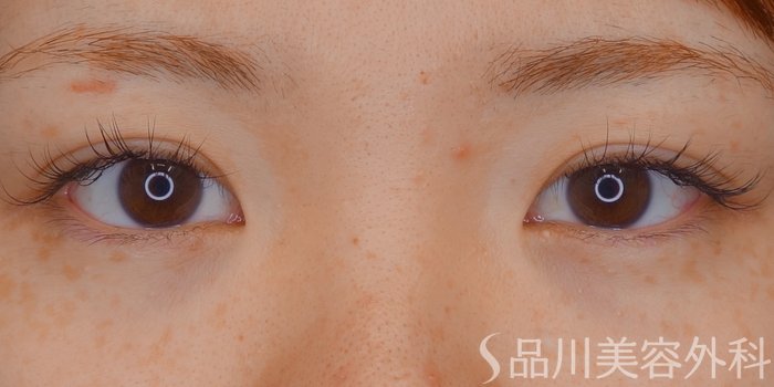症例NO.66906のBEFORE写真