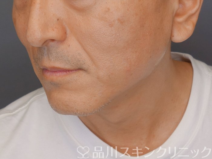 症例NO.71089のAFTER写真