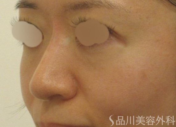 症例NO.72267のAFTER写真