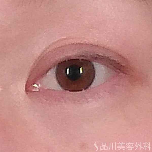 症例NO.69589のAFTER写真