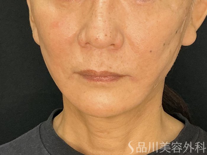 症例NO.71749のAFTER写真