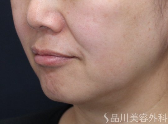 症例NO.74926のBEFORE写真