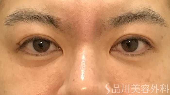 症例NO.65228のAFTER写真