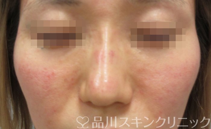 症例NO.70185のAFTER写真