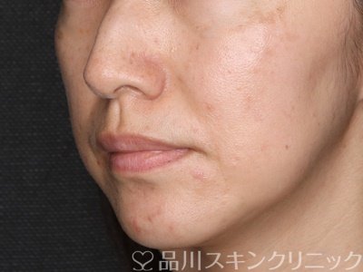 症例NO.71653のAFTER写真