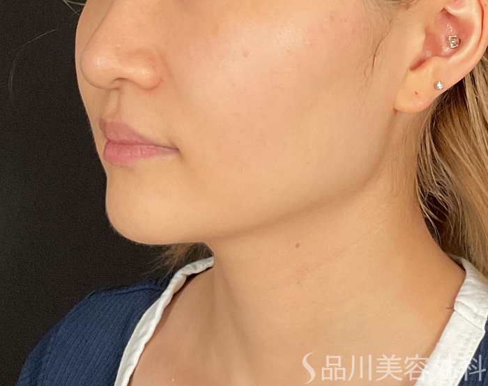 症例NO.74508のBEFORE写真