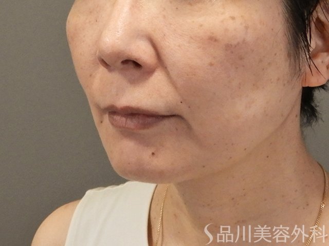 症例NO.74575のBEFORE写真