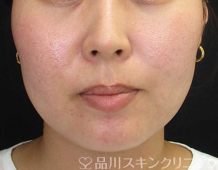 症例NO.67851のBEFORE写真