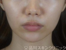 症例NO.74377のAFTER写真