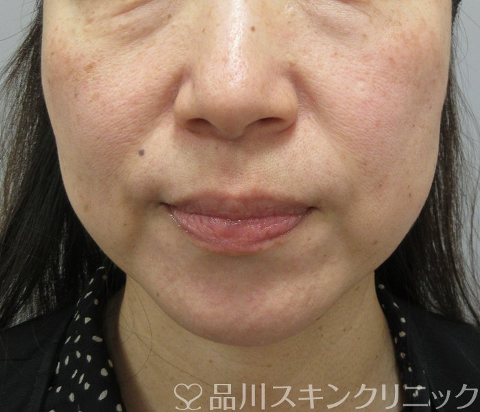 症例NO.74919のBEFORE写真