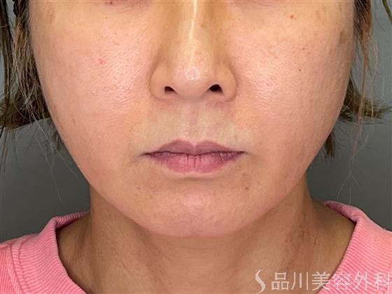 症例NO.51462のBEFORE写真