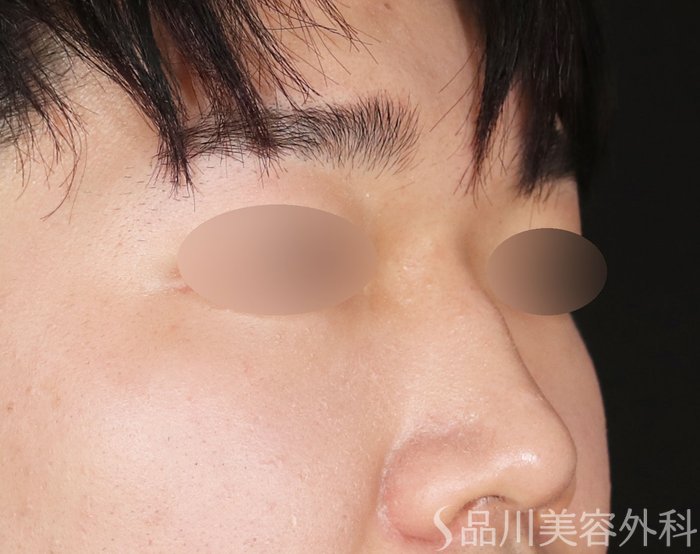 症例NO.72766のBEFORE写真