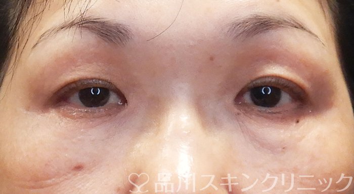 症例NO.72128のAFTER写真