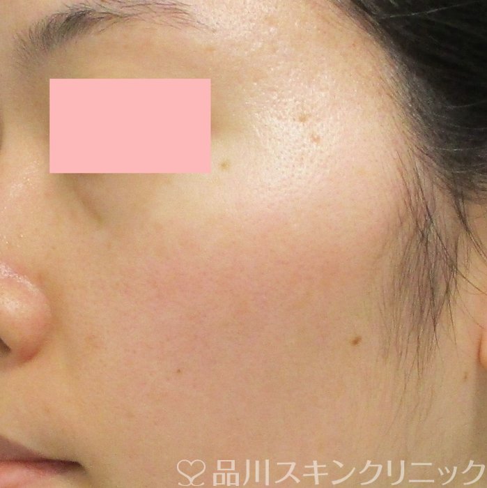 症例NO.71923のAFTER写真