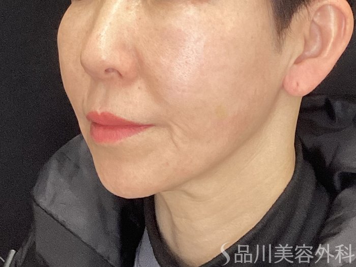 症例NO.72902のBEFORE写真