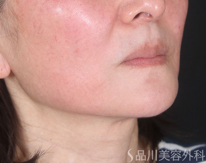 症例NO.73552のBEFORE写真