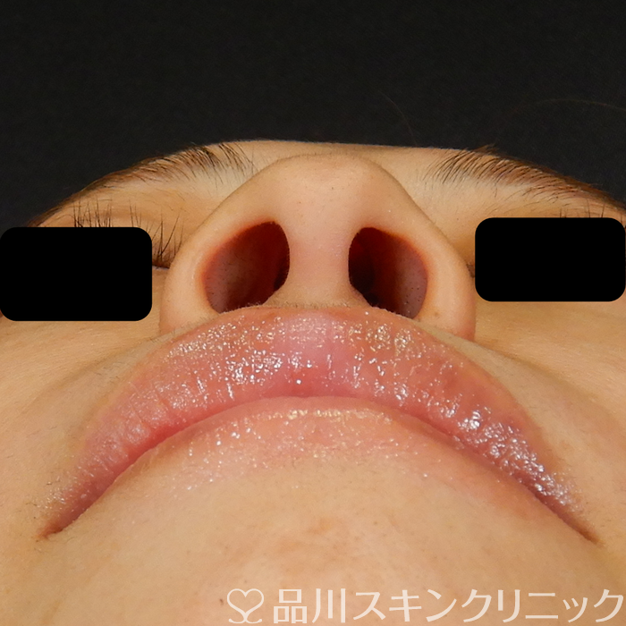 症例NO.69583のBEFORE写真